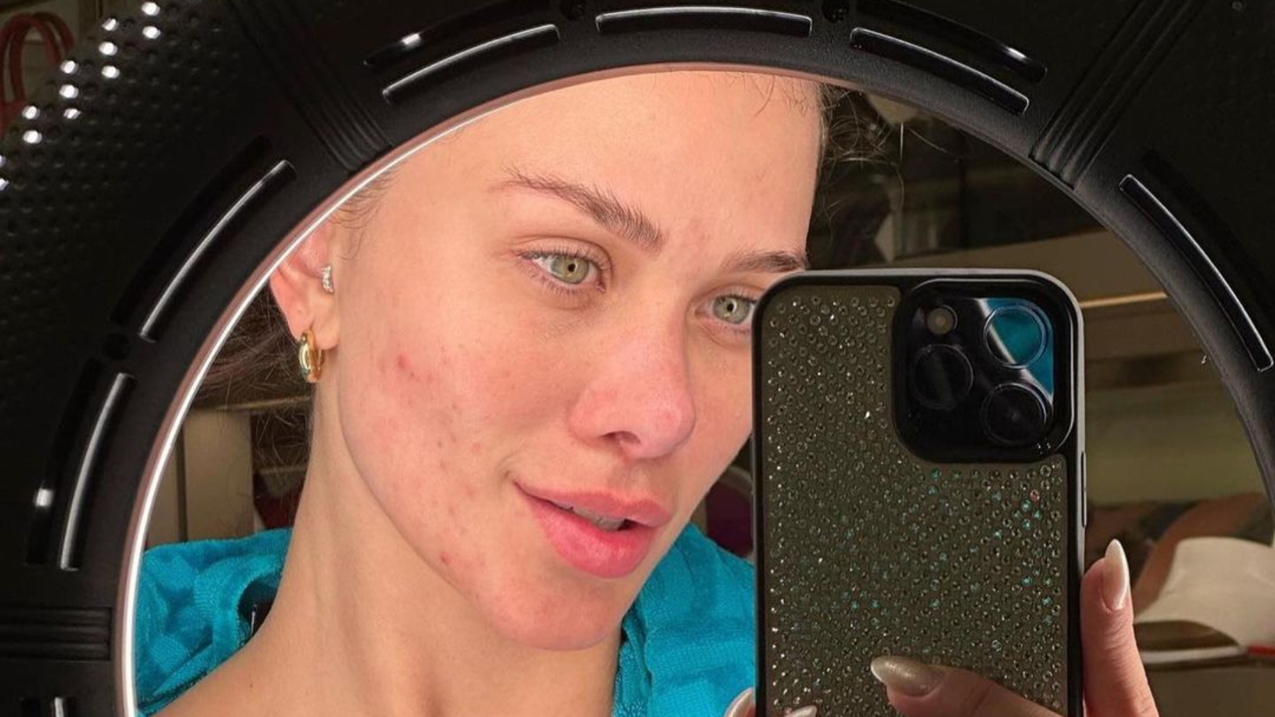 Flavia Pavanelli, com problema de acne, diz que perdeu trabalhos por cobrança da "pele perfeita"