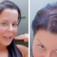 Alopecia feminina: como tratar a doença autoimune que faz famosas perderem cabelo